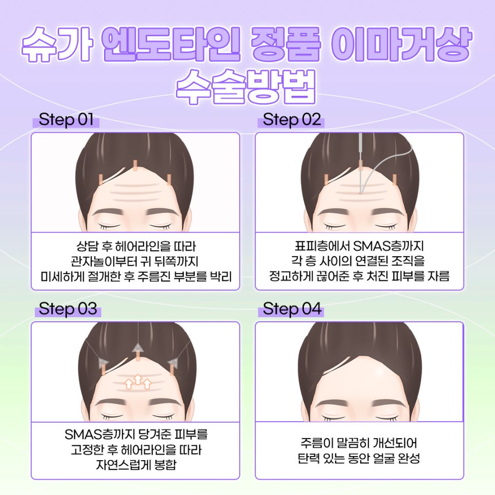 강남역이마거상수술 엔도타인으로 고정점을 확실히 관련 이미지 3