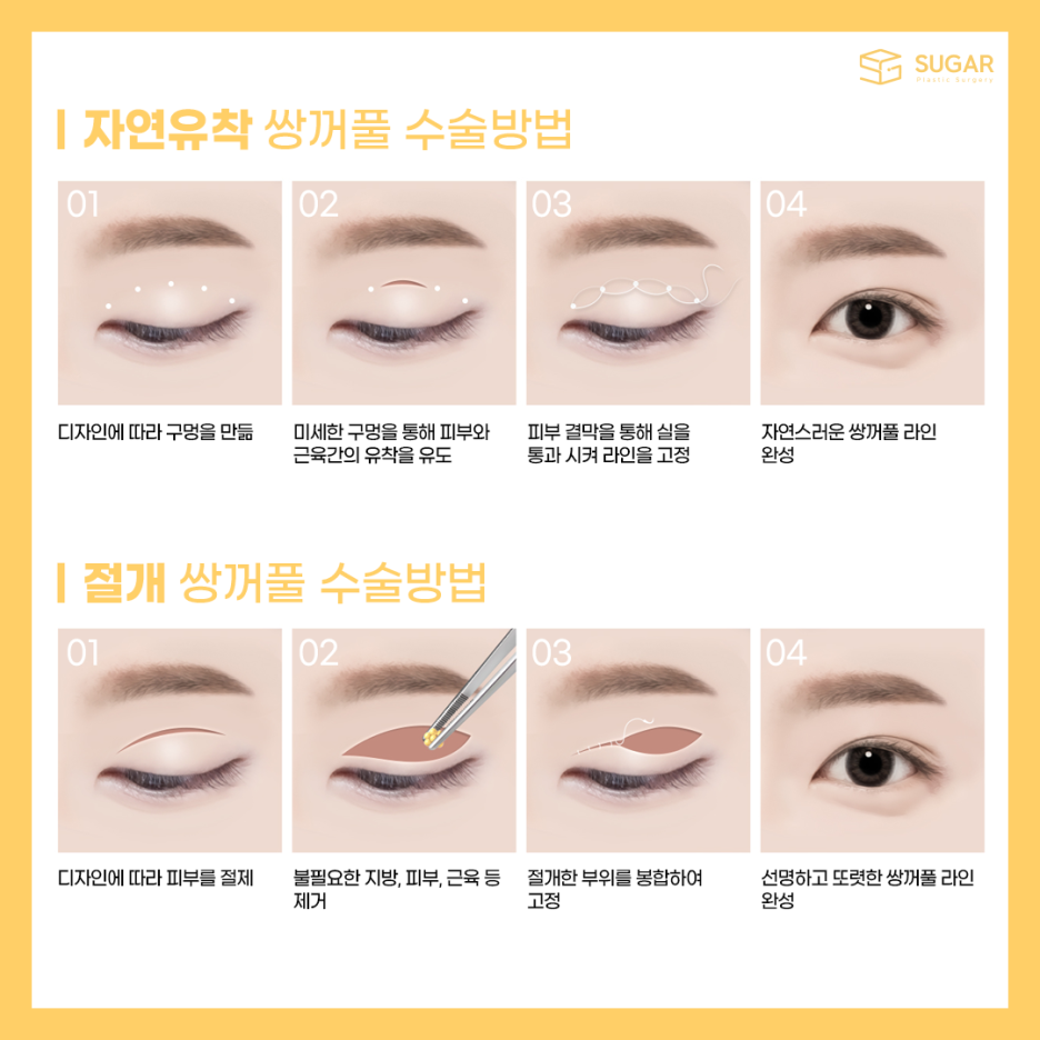 자연유착과 절개의 차이점 관련 이미지 3