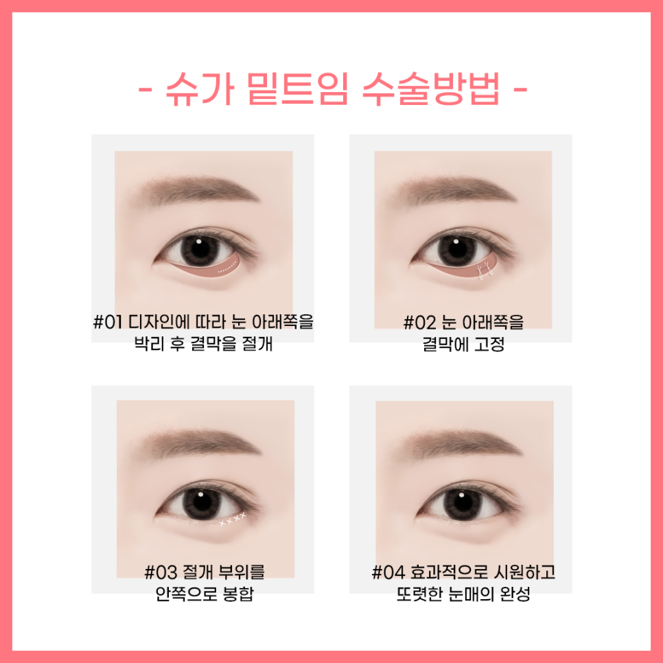 뒷밑트임 붙을까봐 걱정이라면? 관련 이미지 6