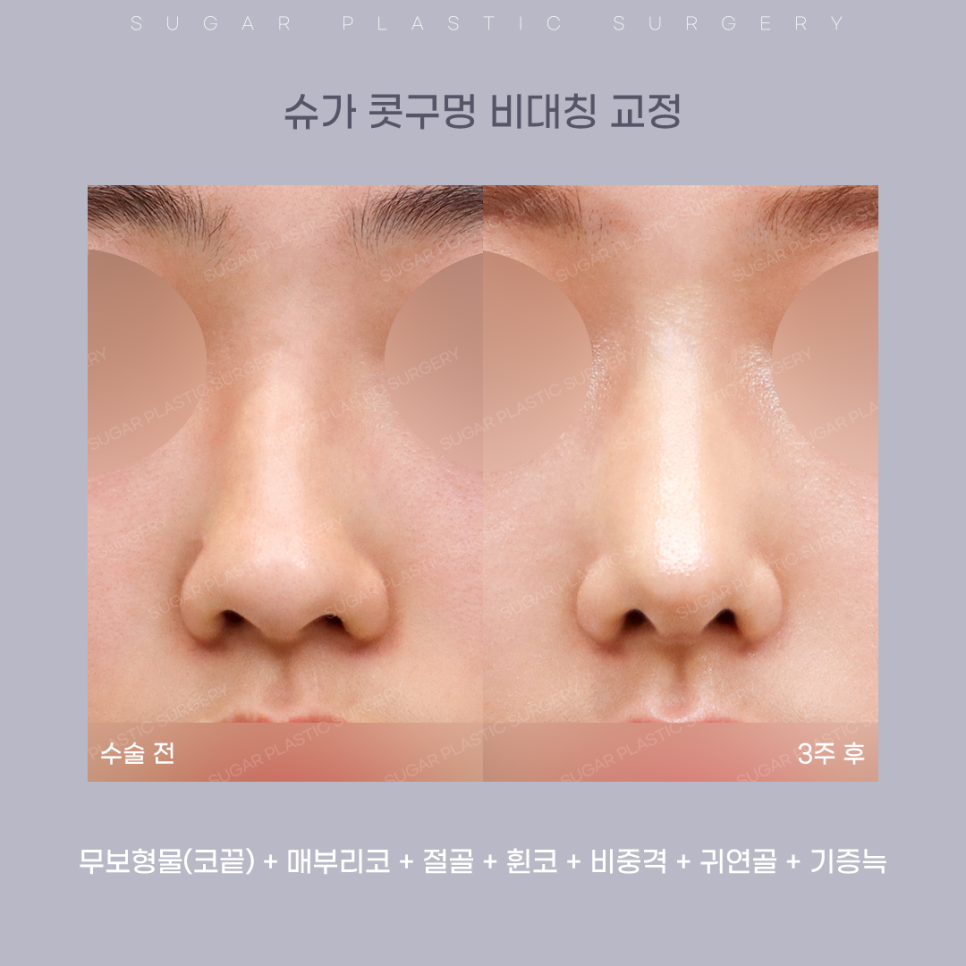 코 성형 후 콧구멍 짝짝이가 되었다?! 관련 이미지 11