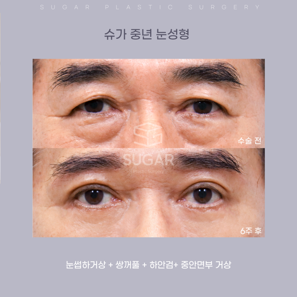 처짐과의 전쟁,중년 눈성형! 나에게 딱 맞는 수술은 관련 이미지 9