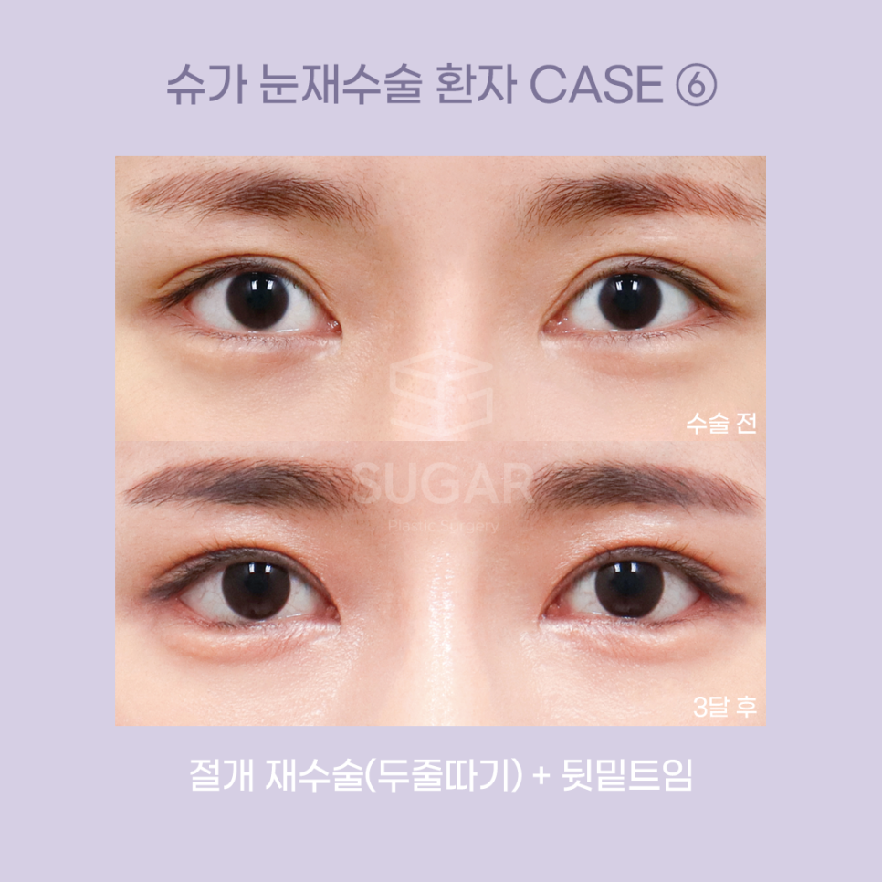 [슈가성형외과] 눈성형 실패하는 이유! 관련 이미지 11
