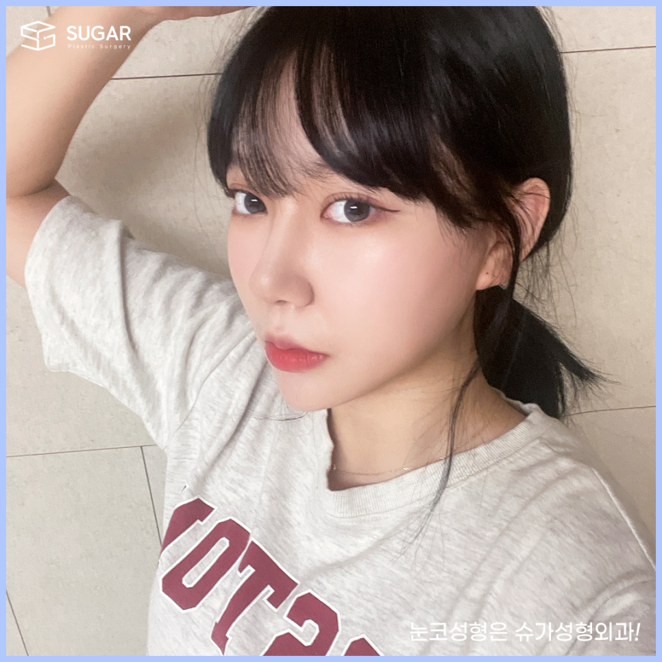 들창코 그 원인과 해결방법 관련 이미지 8