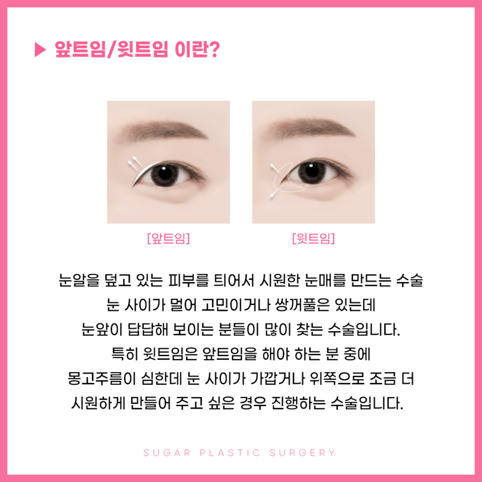 앞윗트임 어디까지 알아봤나요? 관련 이미지 2