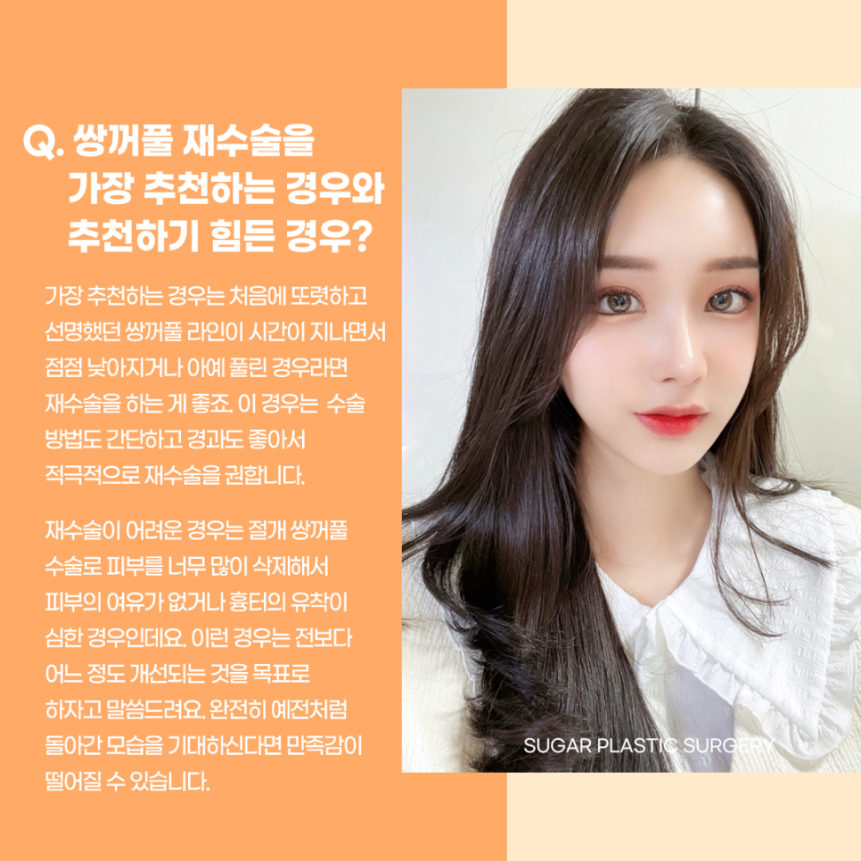 눈재수술 최대 몇 번까지 가능할까? 관련 이미지 6