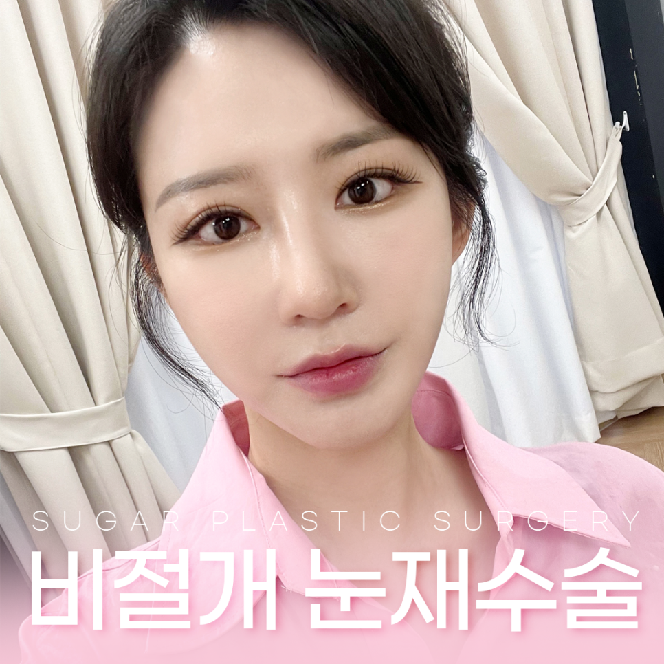 눈재수술 비절개로 가능할까? 관련 이미지 1