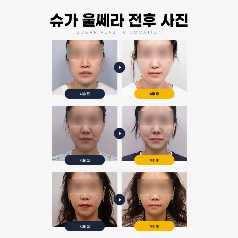 2024년 최신 울쎄라리프팅잘하는곳 관련 이미지 7
