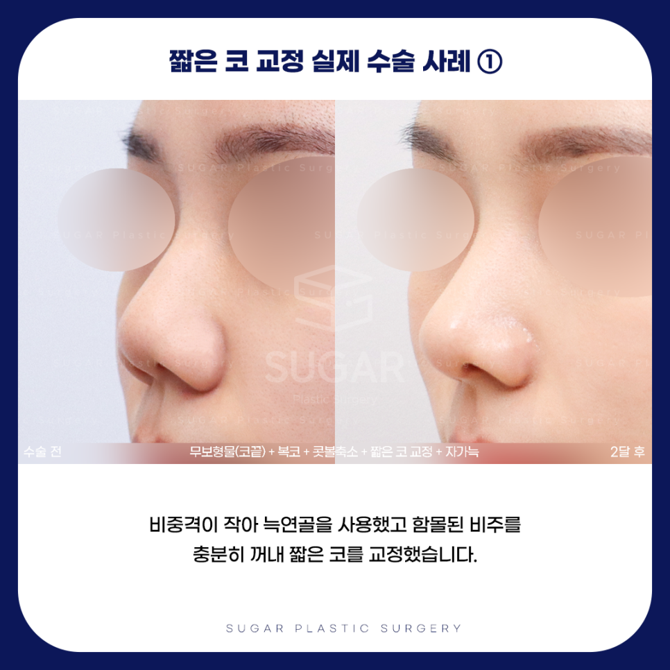 긴코 VS 짧은코 관련 이미지 13