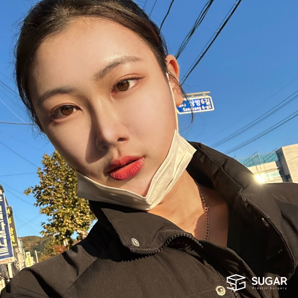 코성형 재료 다 알려드림 관련 이미지 8