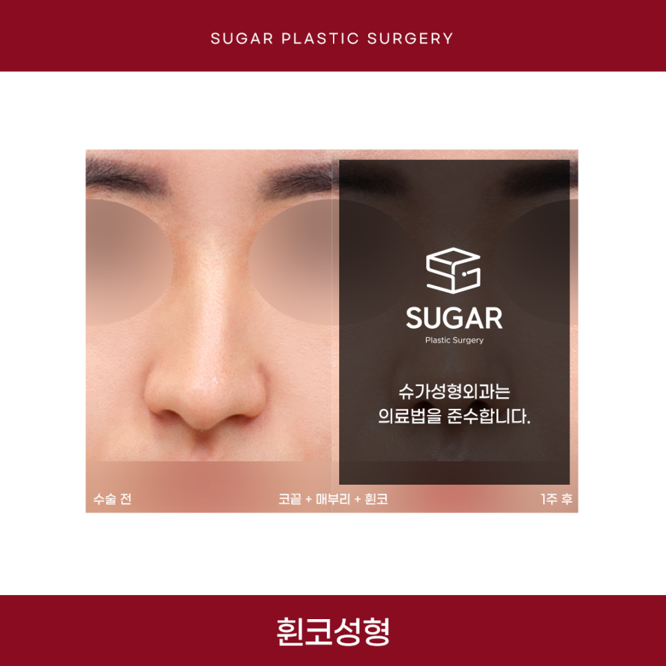 휜코 성형 알아보고 있다면 관련 이미지 11