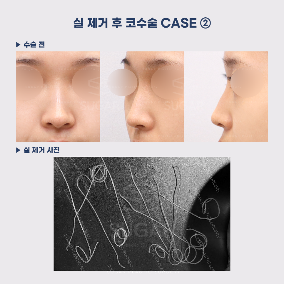 [슈가성형외과] 이런 코시술 하지마세요 관련 이미지 8