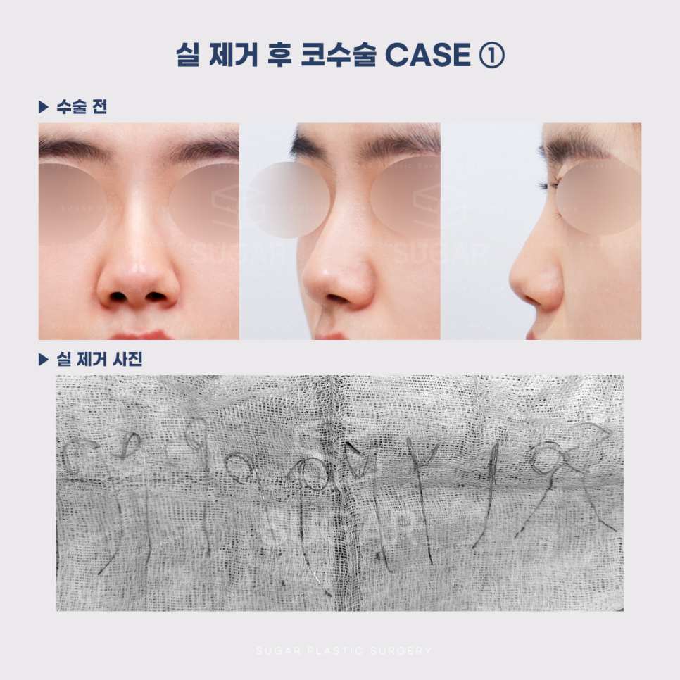 [슈가성형외과] 이런 코시술 하지마세요 관련 이미지 4