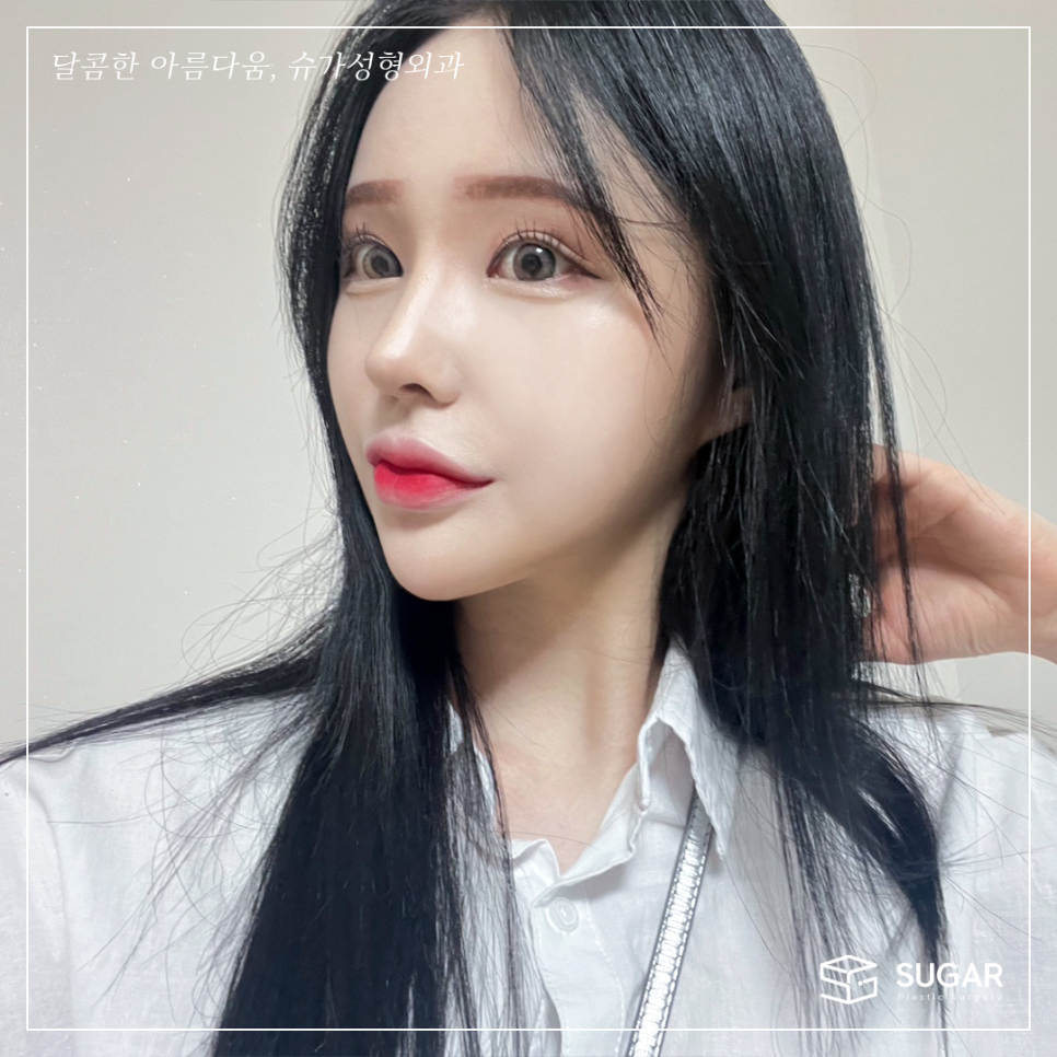 코재수술 마지막이 되려면 관련 이미지 3