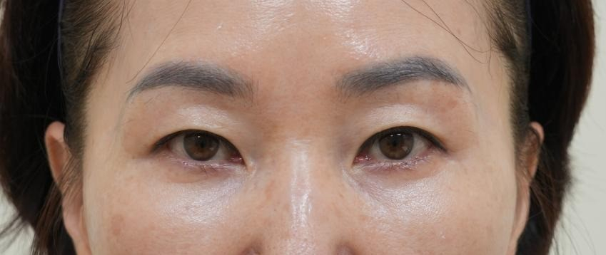 [눈성형] 나는 50대인데 무조건 하안검을 해야하나? 관련 이미지 3