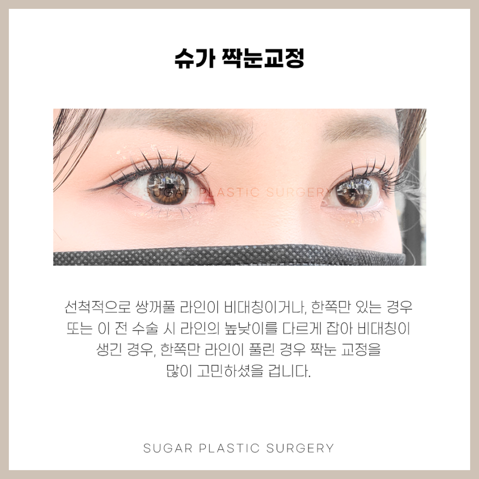 짝눈교정 어떻게 알아볼까 관련 이미지 2