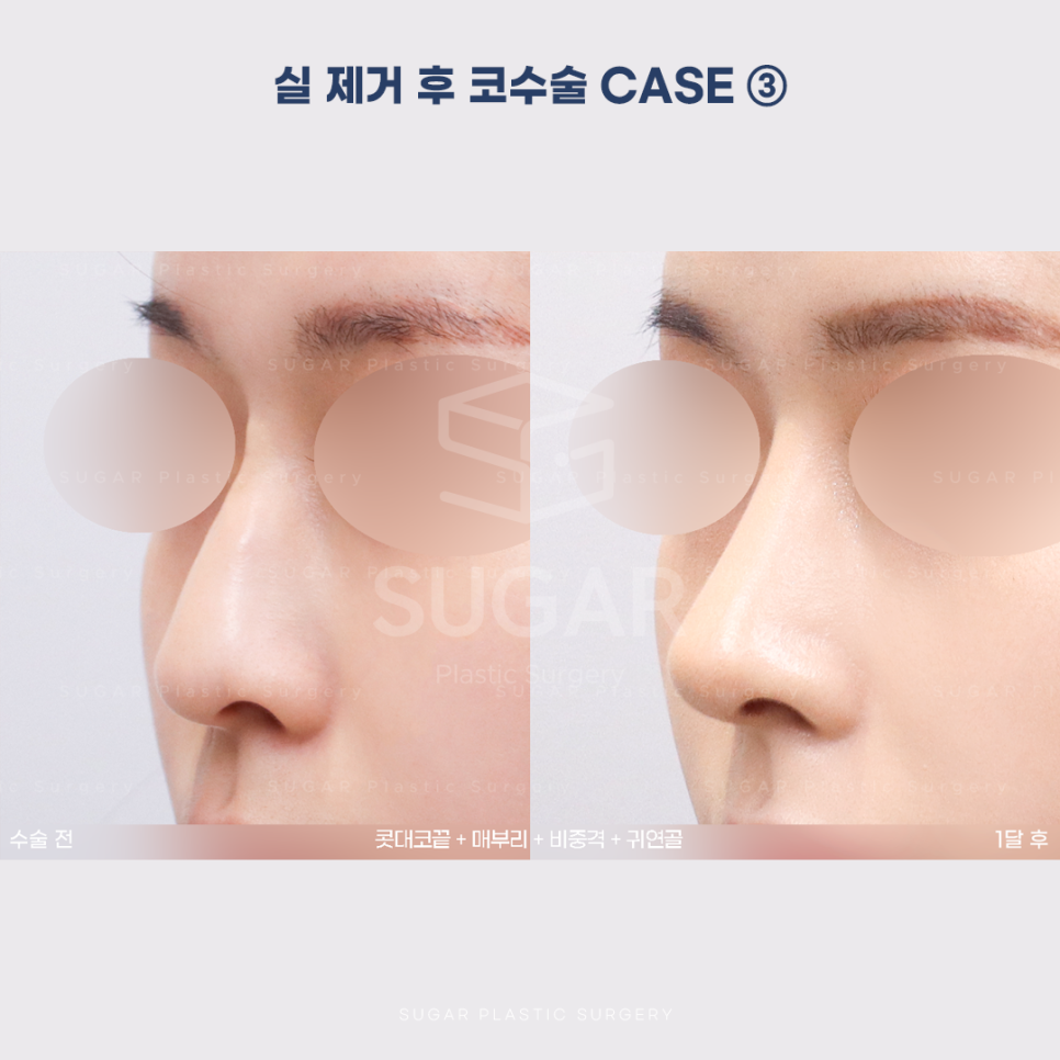 [슈가성형외과] 이런 코시술 하지마세요 관련 이미지 15