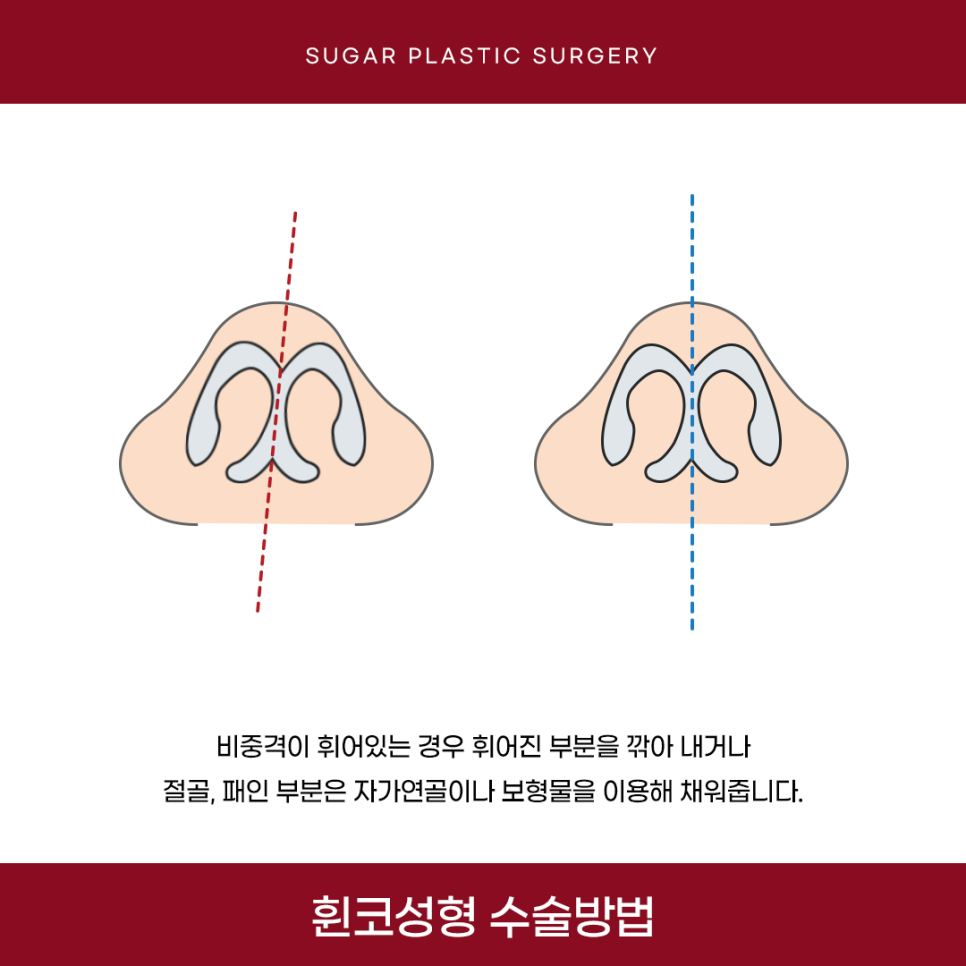 휜코 성형 알아보고 있다면 관련 이미지 9