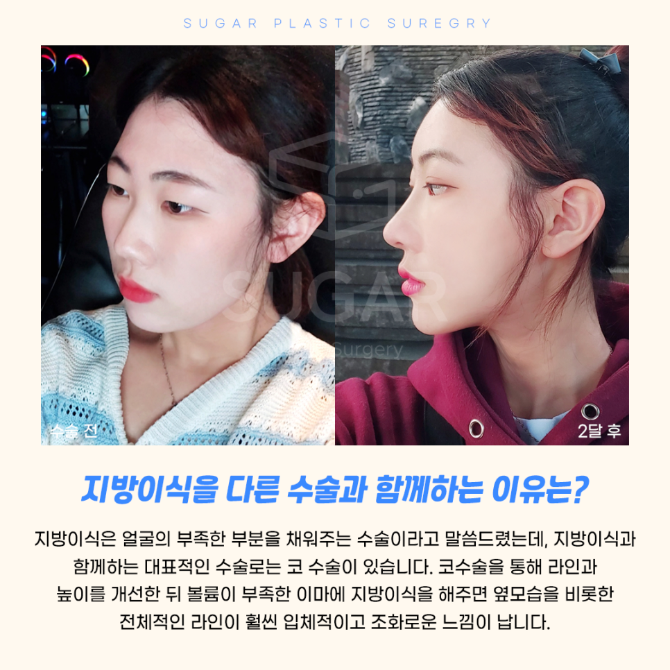 지방이식 vs 필러 어떤게 좋을까 관련 이미지 4
