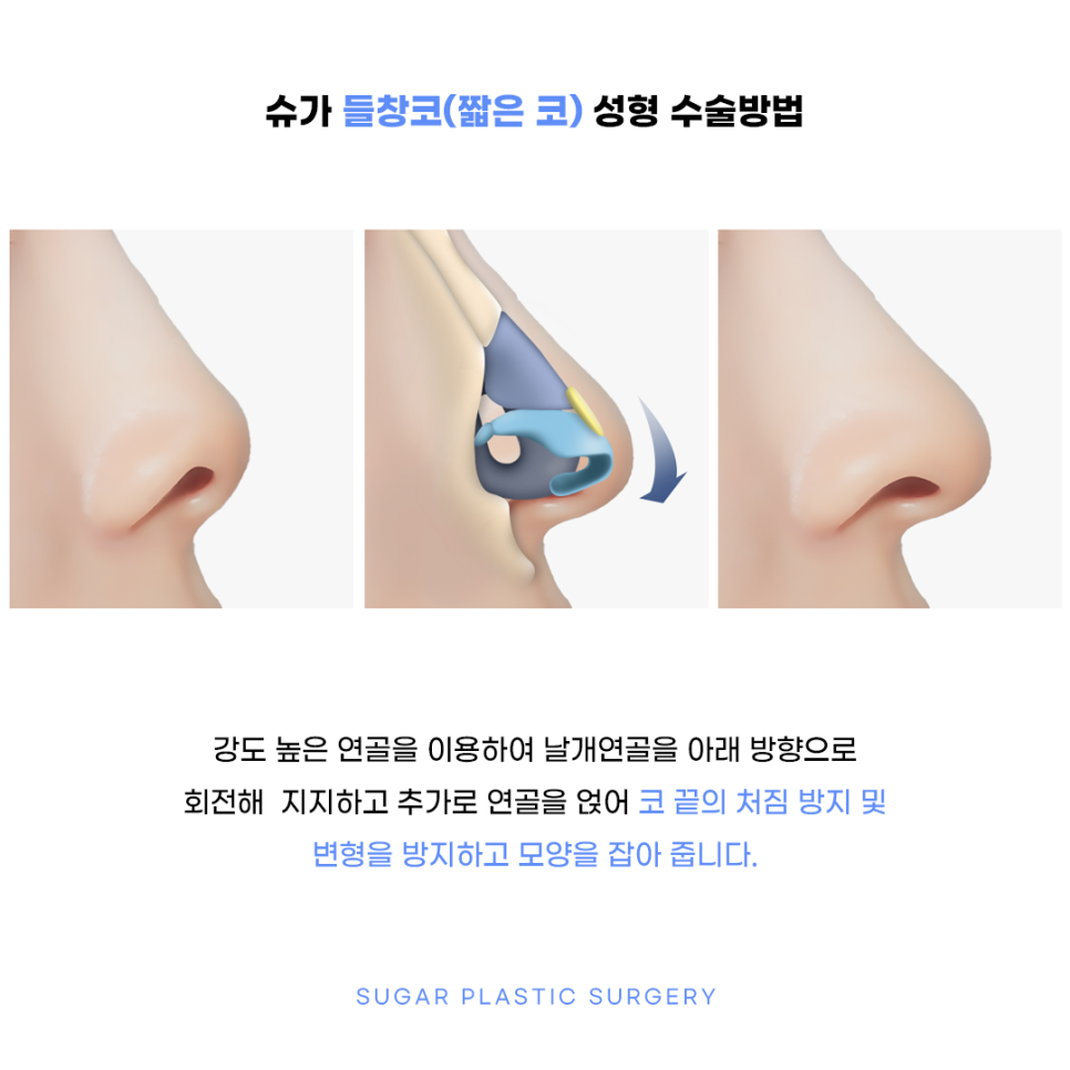 들창코 그 원인과 해결방법 관련 이미지 4
