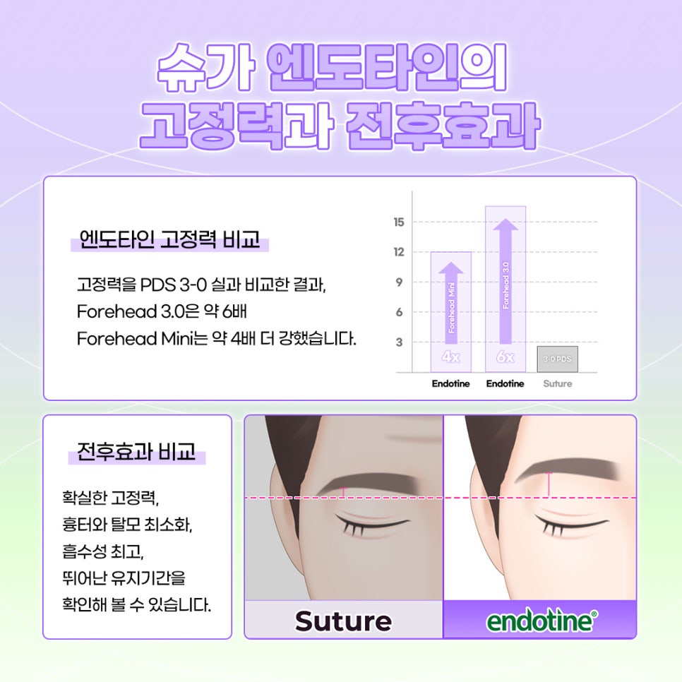 강남역이마거상수술 엔도타인으로 고정점을 확실히 관련 이미지 5