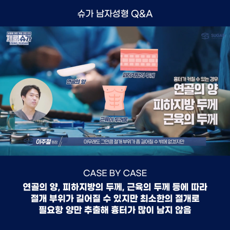 남자성형에 관한 궁금한 점 다 알려드립니다! 관련 이미지 8
