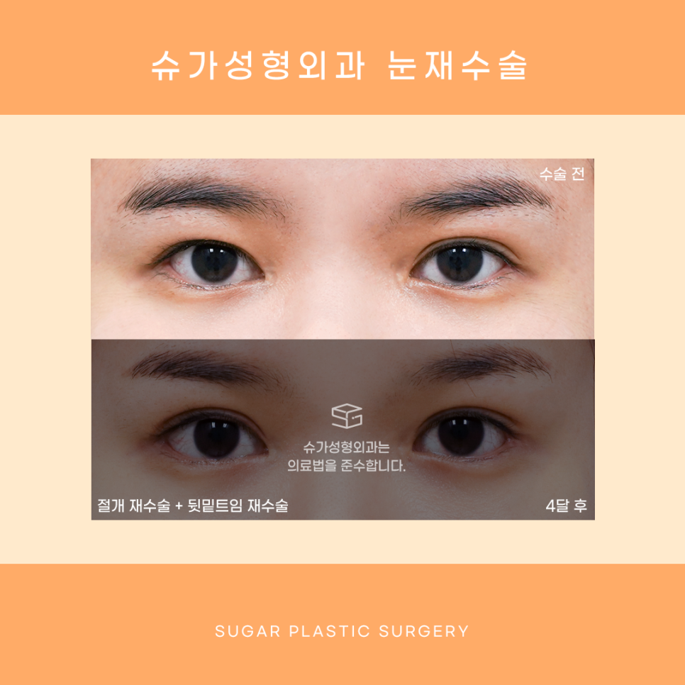 눈재수술 최대 몇 번까지 가능할까? 관련 이미지 3