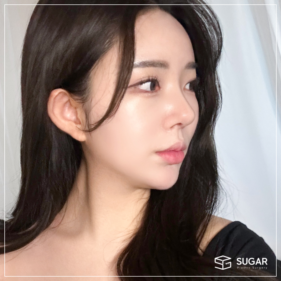 코 유형에 따른 코성형 방법 관련 이미지 7