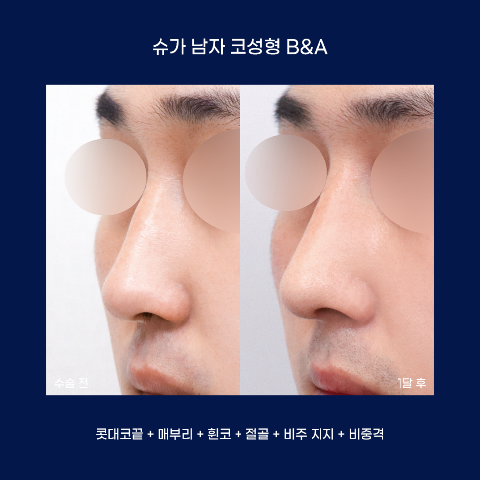 남자성형에 관한 궁금한 점 다 알려드립니다! 관련 이미지 16