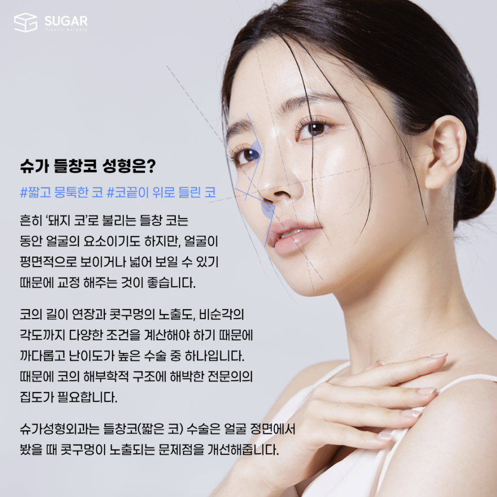 들창코 그 원인과 해결방법 관련 이미지 2