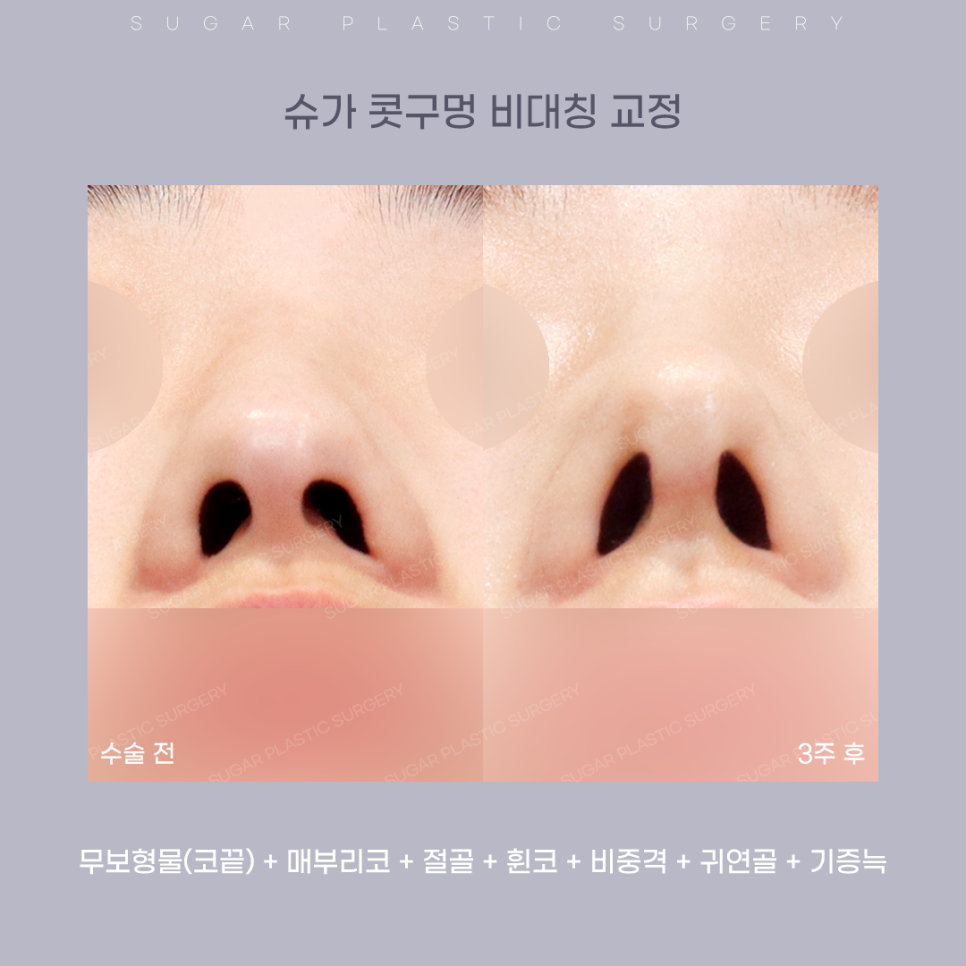 코 성형 후 콧구멍 짝짝이가 되었다?! 관련 이미지 12