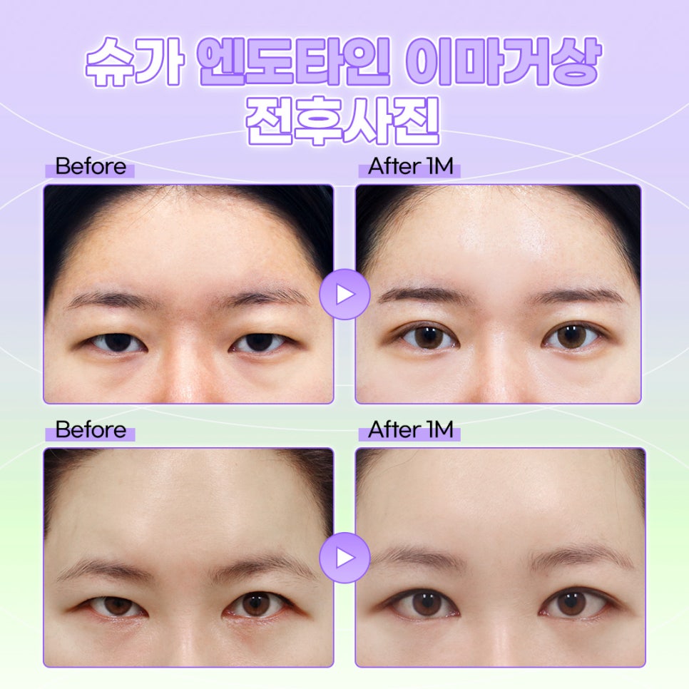 강남역이마거상수술 엔도타인으로 고정점을 확실히 관련 이미지 9