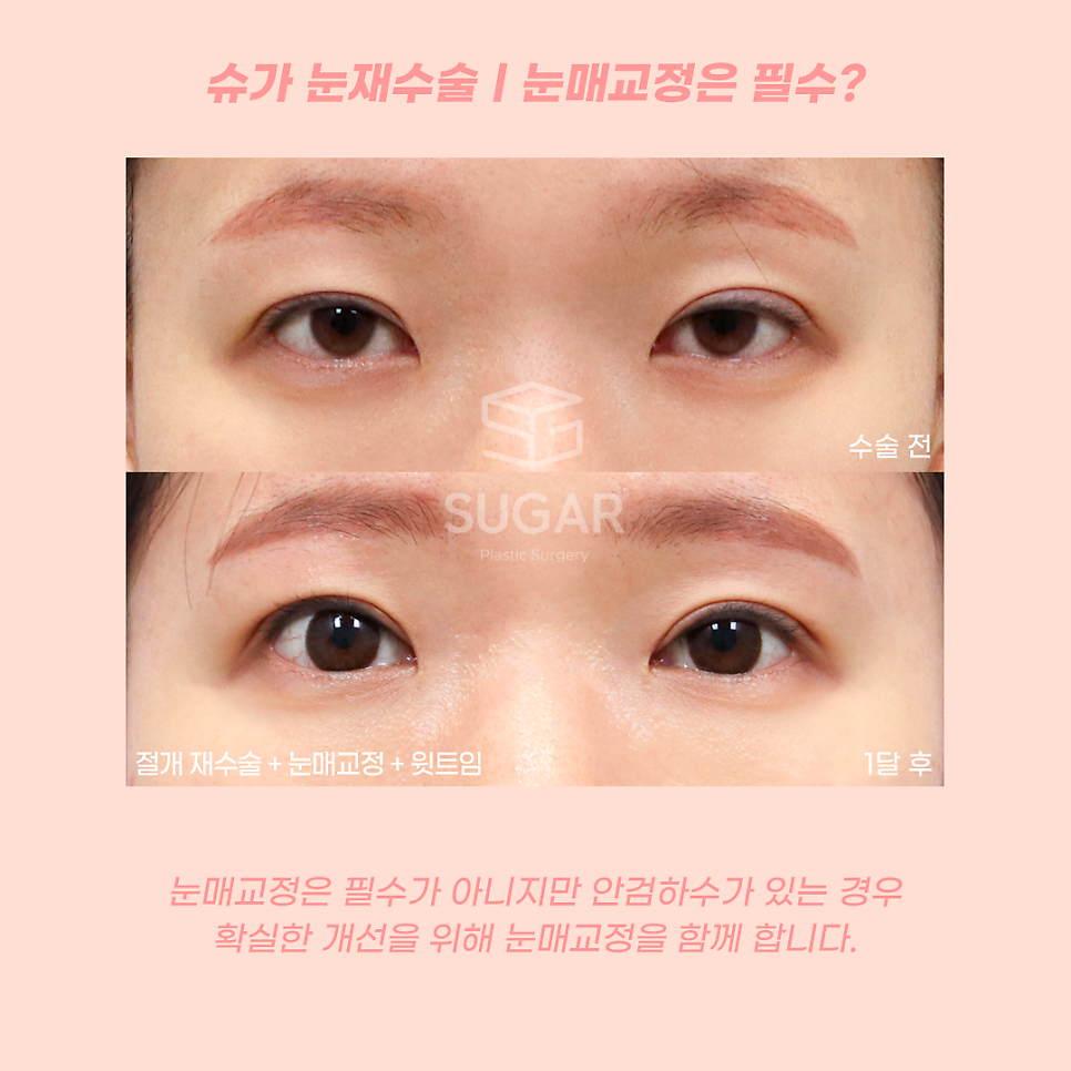 눈재수술 라인높이는 방법 관련 이미지 7