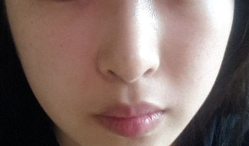 Q. After surgery for an upturned nose, it became a hooked nose. What is the solution? image 3
