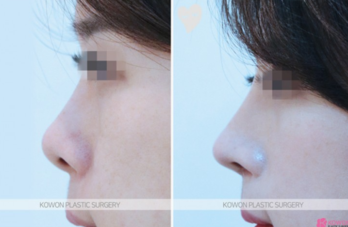 Q. After nose surgery, I can’t make a pig nose. Will removing the silicone fix it? image 5
