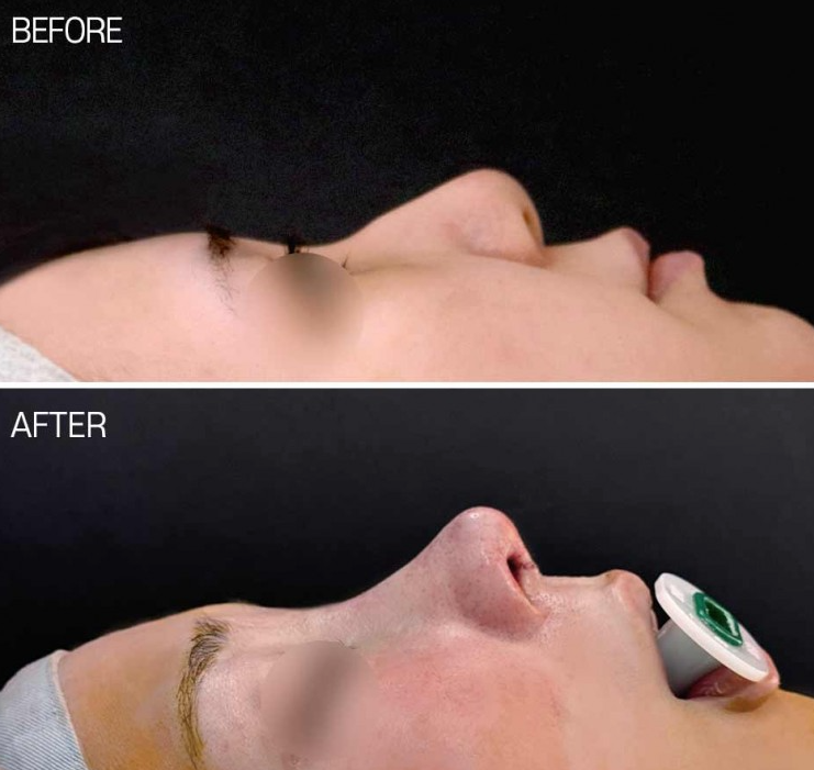 Q. Rhinoplasty precautions: After nose surgery, is it okay if my glasses press on my nose? image 3