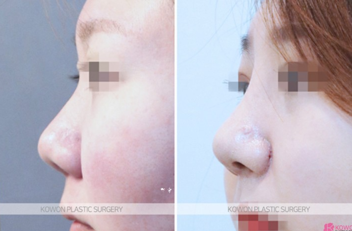 Q. Can upturned nose surgery make uneven nostrils symmetrical if the nose is crooked? image 5