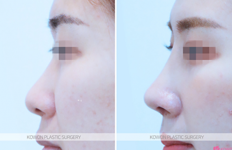 Q. Learn About Changes Before and After Alar Reduction Surgery Without Implants and Alar Reduction Surgical Methods image 10