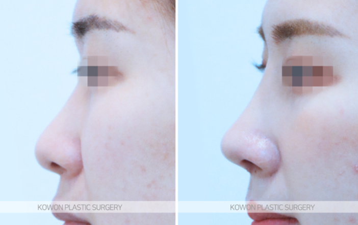 Q. Are there differences in nostril shape depending on the type of nose surgery and incision method, or not? image 7