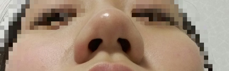 Q. I’m planning to get a nose job—please tell me the types of rhinoplasty (bulbous nose surgery) image 4