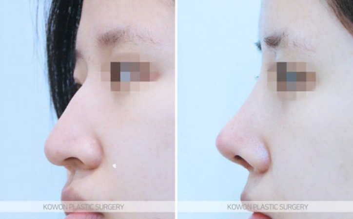 Q. Changes Before and After Hump Nose Surgery: Checking Whether a Nose Tip Dent After Rhinoplasty Is a Side Effect image 7