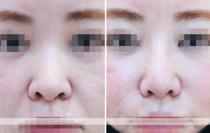 Q. I heard that 10 years after nose surgery, revision surgery is mandatory. Is that true? image 4