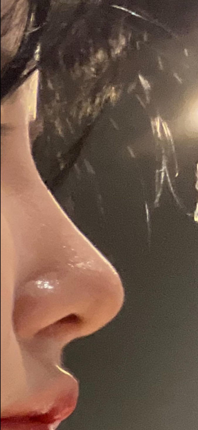 울퉁불퉁해 신경 쓰이던 코를 코원성형외과에서 낮은코와 매부리코교정으로 매끄럽게 만들었어요! 관련 이미지 8
