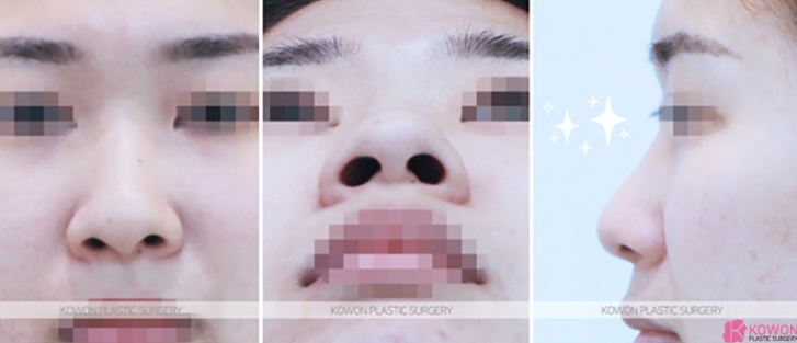 Q. Worried about inflammation after nose surgery, is severe pain after suture removal normal? image 3