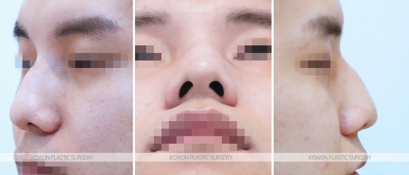 What Are the Criteria for Choosing a Good Place for Men’s Rhinoplasty? A Summary of Changes Before and After a Hump Nose Correction image 4