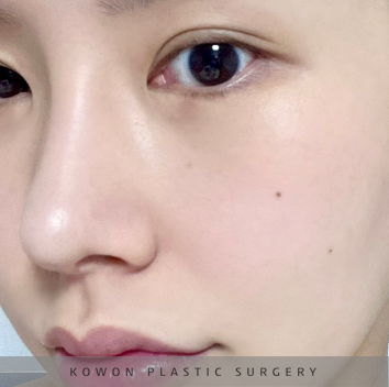 과도하게 화려한코, 귀연골에 비중격코수술로 자연스럽게 개선 됐어요! 관련 이미지 25