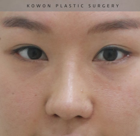 자가늑 코재수술로 비순각수술을 해서 저에게 어울리는 코를 찾았어요! 관련 이미지 11