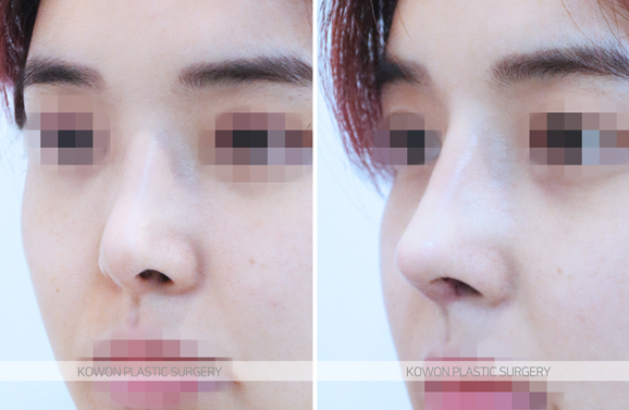 Q. My nose looks artificial because of swelling after bulbous nose surgery. Should I get revision rhinoplasty? image 7