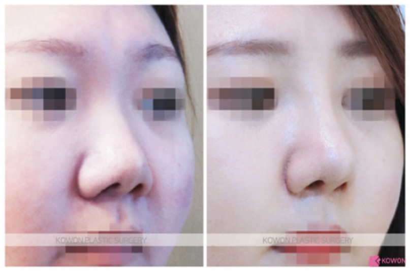 콧날개수술, 단순히 콧볼만 줄이는 수술일까요? | 코원성형외과 관련 이미지 4