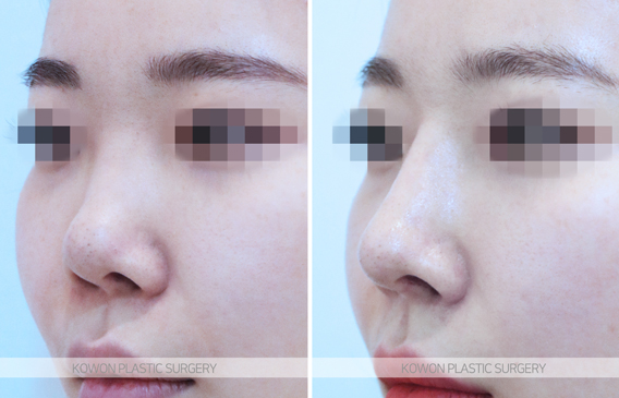 Q. Revision Rhinoplasty Clinic: Can a Crooked Nose Caused by a Bump After Nose Surgery Be Revised? image 5