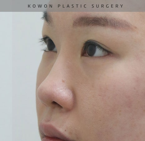 자가늑 코재수술로 비순각수술을 해서 저에게 어울리는 코를 찾았어요! 관련 이미지 5